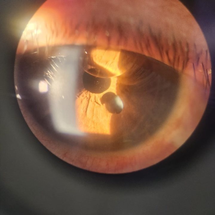 Detalle clínico intraocular