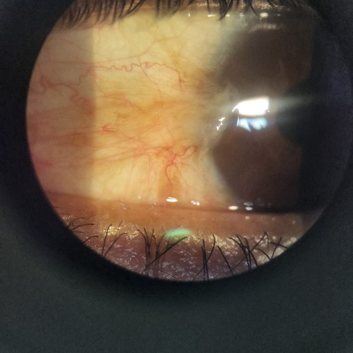 Exploración clínica de retina